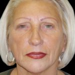 Browlift Before & After Patient #1461