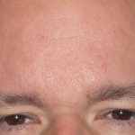 Browlift Before & After Patient #1471