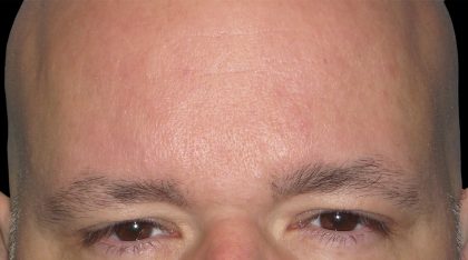 Browlift Before & After Patient #1471