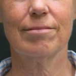 Levinelift Before & After Patient #1999
