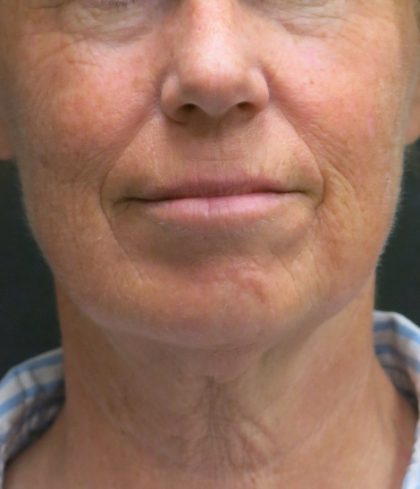 Levinelift Before & After Patient #1999