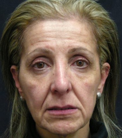 Levinelift Before & After Patient #1988
