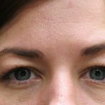 Eyelid Surgery Before & After Patient #1605
