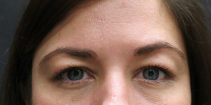 Eyelid Surgery Before & After Patient #1605