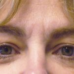 Eyelid Surgery Before & After Patient #1615