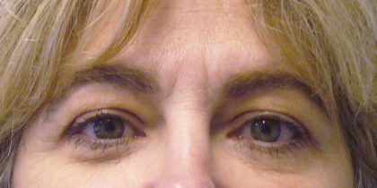 Eyelid Surgery Before & After Patient #1615
