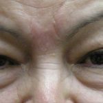 Eyelid Surgery Before & After Patient #1597