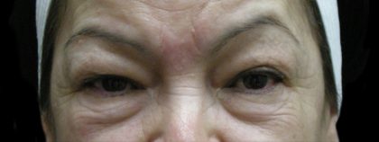Eyelid Surgery Before & After Patient #1597