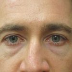 Eyelid Surgery Before & After Patient #1600