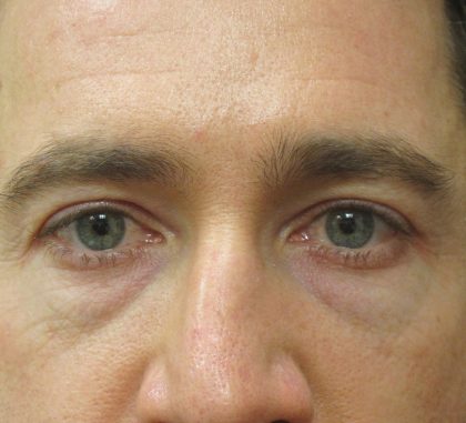 Eyelid Surgery Before & After Patient #1600
