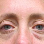 Eyelid Surgery Before & After Patient #1592