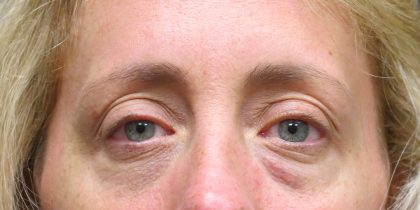 Eyelid Surgery Before & After Patient #1592
