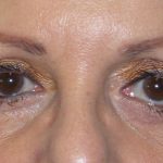 Eyelid Surgery Before & After Patient #1610