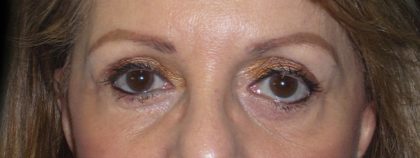 Eyelid Surgery Before & After Patient #1610