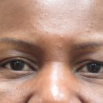 Eyelid Surgery Before & After Patient #1587