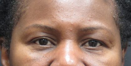 Eyelid Surgery Before & After Patient #1587