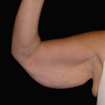 Arm Lift Before & After Patient #922
