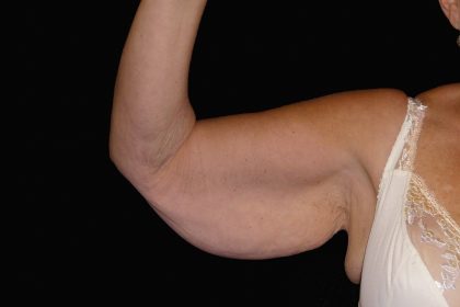 Arm Lift Before & After Patient #922