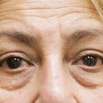 Eyelid Surgery Before & After Patient #1625