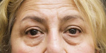 Eyelid Surgery Before & After Patient #1625