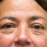 Eyelid Surgery Before & After Patient #1620