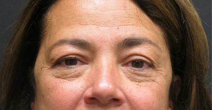 Eyelid Surgery Before & After Patient #1620