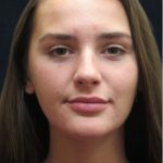 Rhinoplasty Before & After Patient #2926
