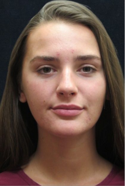 Rhinoplasty Before & After Patient #2926