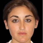 Rhinoplasty Before & After Patient #2919