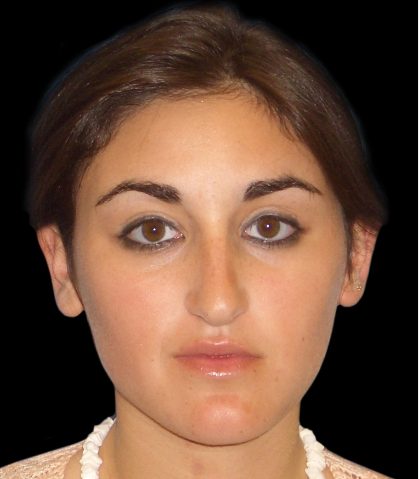 Rhinoplasty Before & After Patient #2919