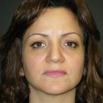 Rhinoplasty Before & After Patient #2805