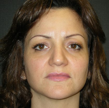 Rhinoplasty Before & After Patient #2805