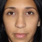 Rhinoplasty Before & After Patient #2912
