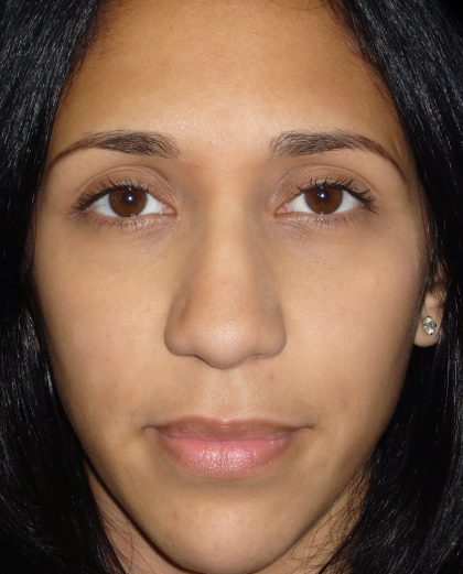 Rhinoplasty Before & After Patient #2912