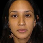 Rhinoplasty Before & After Patient #2905