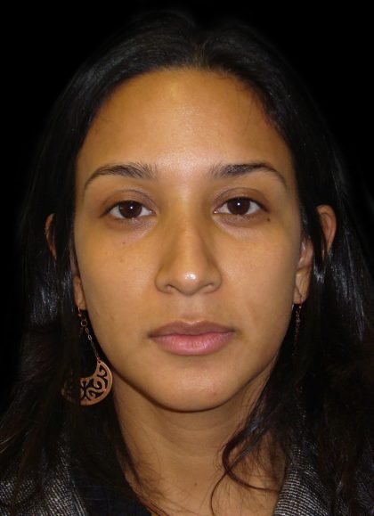 Rhinoplasty Before & After Patient #2905