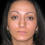 Rhinoplasty Before & After Patient #2819