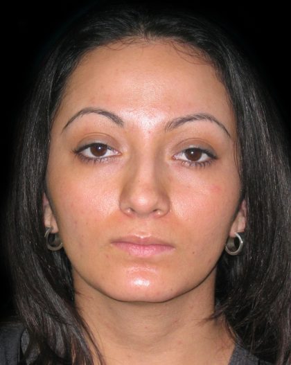 Rhinoplasty Before & After Patient #2819