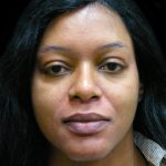Rhinoplasty Before & After Patient #2812