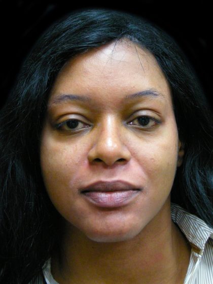 Rhinoplasty Before & After Patient #2812