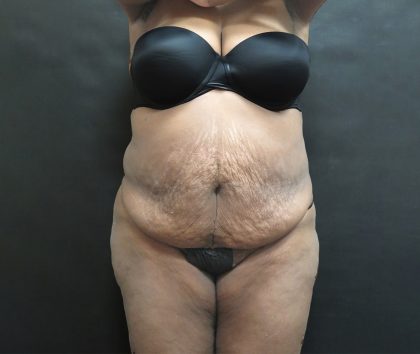 Mommy Makeover Before & After Patient #2503