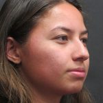 Rhinoplasty Before & After Patient #2798