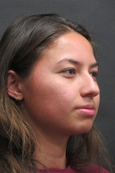 Rhinoplasty Before & After Patient #2798