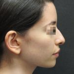 Rhinoplasty Before & After Patient #2863