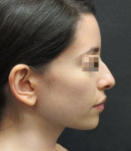 Rhinoplasty Before & After Patient #2863
