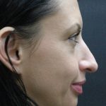 Rhinoplasty Before & After Patient #2877