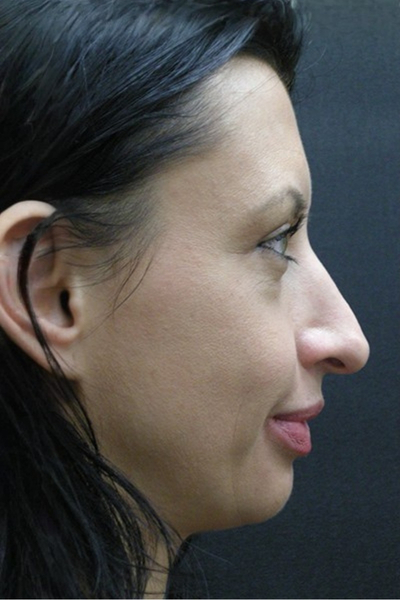 Rhinoplasty Before & After Patient #2877