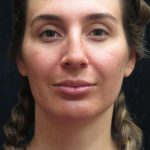 Rhinoplasty Before & After Patient #2851