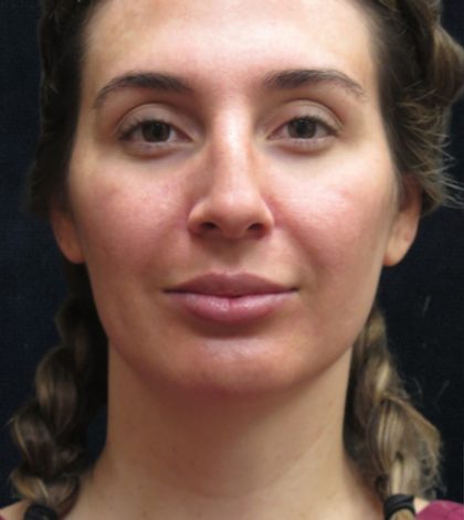 Rhinoplasty Before & After Patient #2851