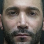Rhinoplasty Before & After Patient #2884